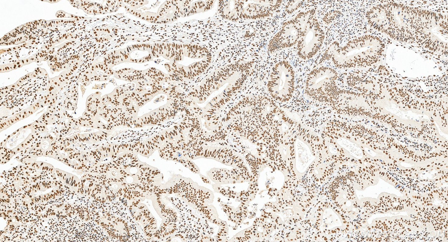 IHC staining of human colon cancer using 22638-1-AP