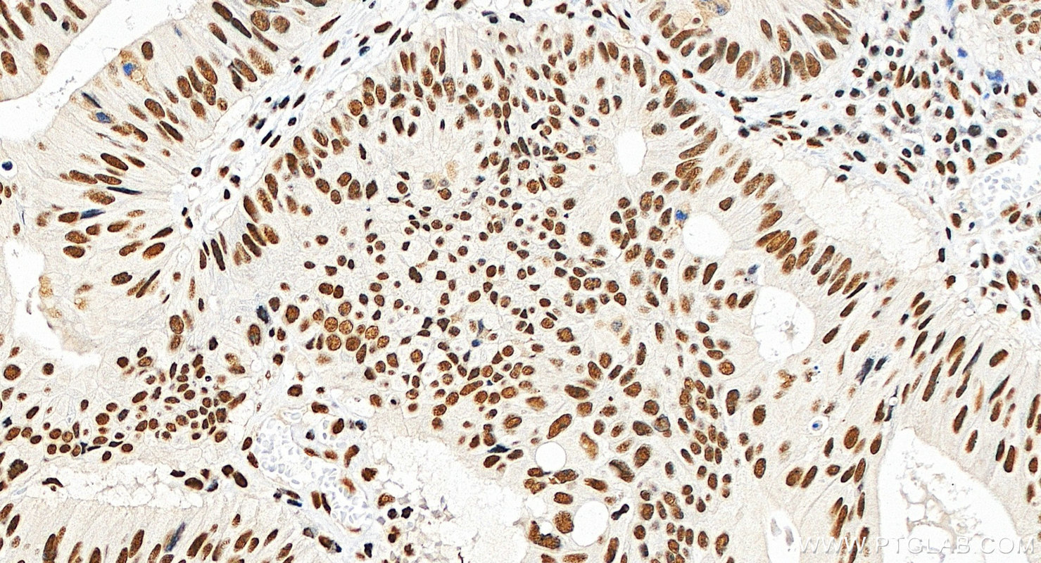 IHC staining of human colon cancer using 22638-1-AP
