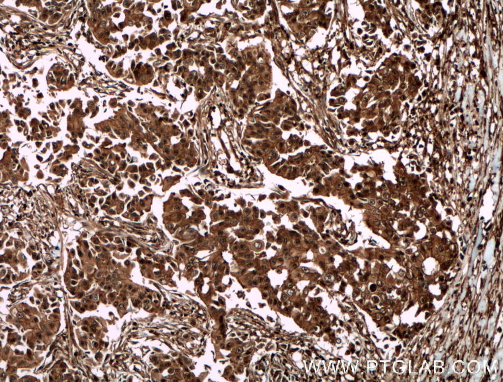 IHC staining of human breast cancer using 13015-1-AP