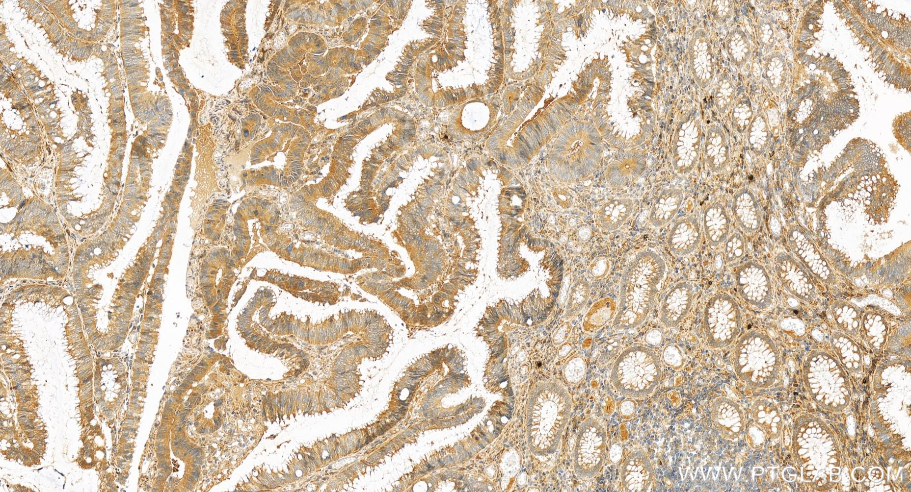 IHC staining of human colon cancer using 85000-4-RR (same clone as 85000-4-PBS)