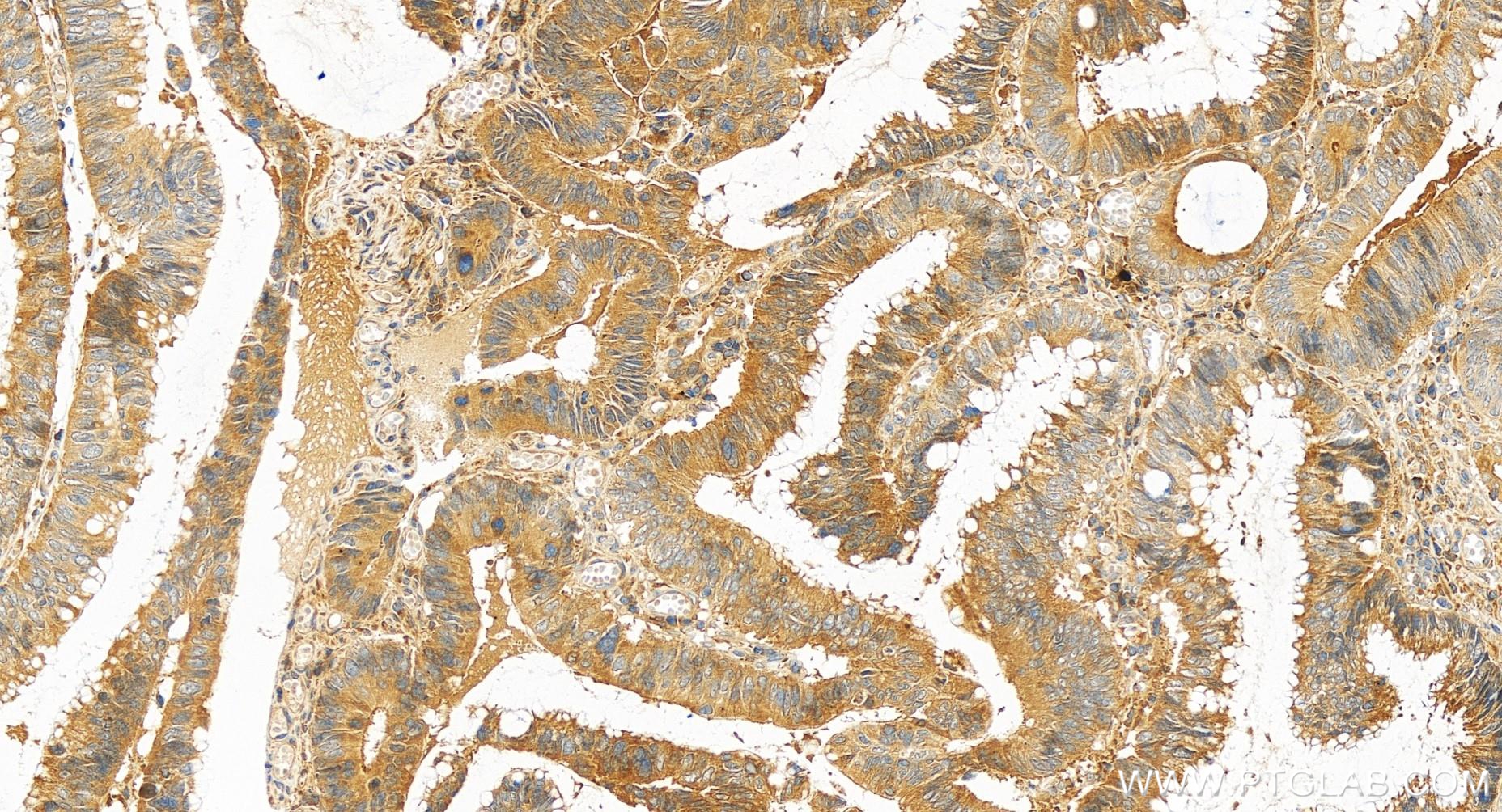 IHC staining of human colon cancer using 85000-4-RR (same clone as 85000-4-PBS)
