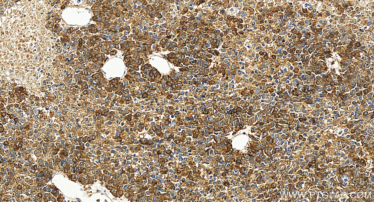 Immunohistochemical analysis of paraffin-embedded human Hepatocellular carcinoma slide using 26978-1-AP (DCDC2 antibody) at dilution of 1:2000 (under 20x lens). Heat mediated antigen retrieval with Tris-EDTA buffer (pH 9.0). IHC staining of human Hepatocellular carcinoma using 26978-1-AP