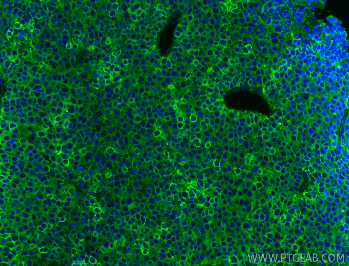 Immunofluorescent analysis of (4% PFA) fixed paraffin-embedded human liver cancer tissue using DCDC2 antibody (26978-1-AP) at dilution of 1:200 and CoraLite®488-Conjugated Goat Anti-Rabbit IgG(H+L) (<a class='green' href='/productredirect?CatalogNo=SA00013-2' target='_blank'>SA00013-2</a>). Heat mediated antigen retrieval with Tris-EDTA buffer (pH 9.0). IF Staining of human liver cancer using 26978-1-AP
