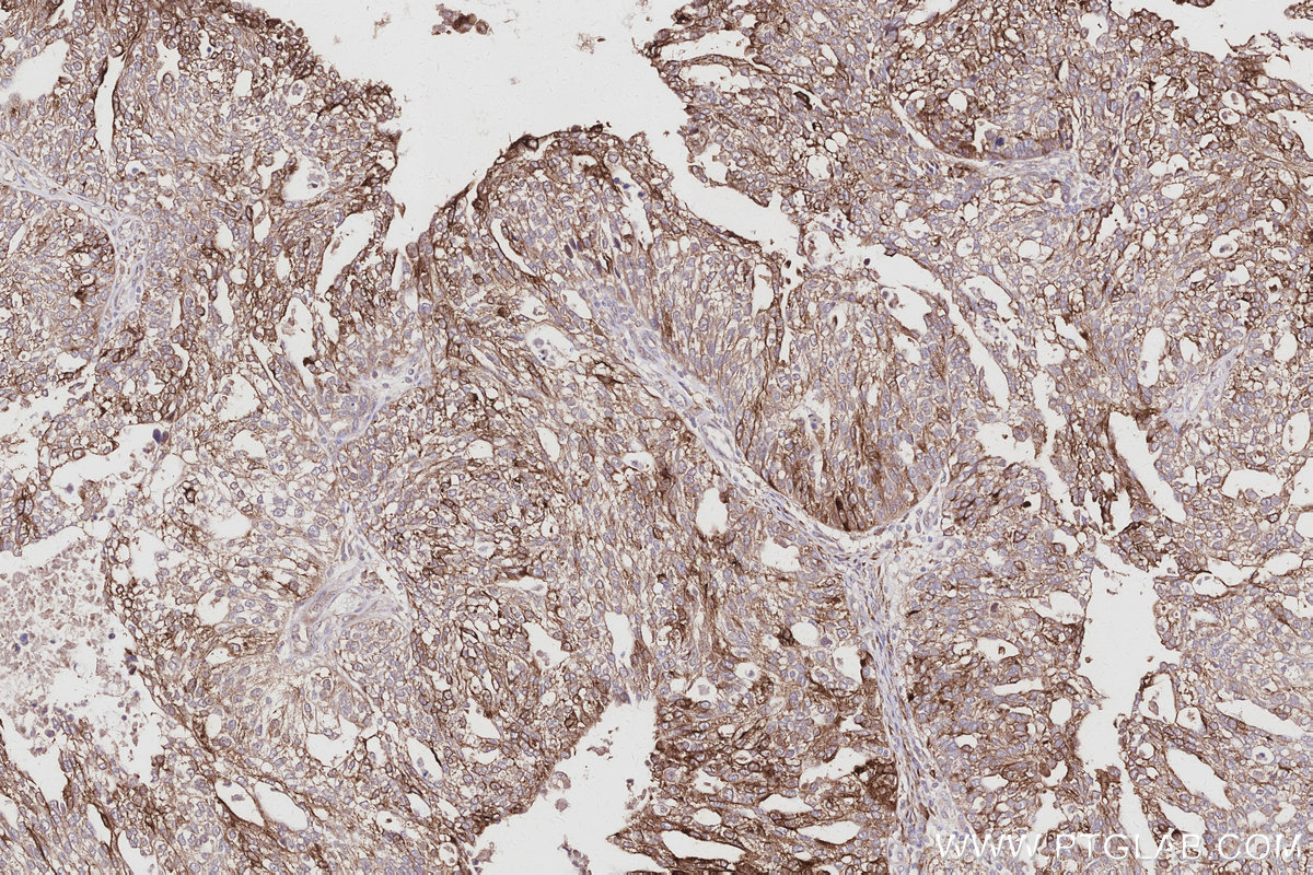 IHC staining of human ovary cancer using 26978-1-AP IHC staining of human ovary cancer using 26978-1-AP