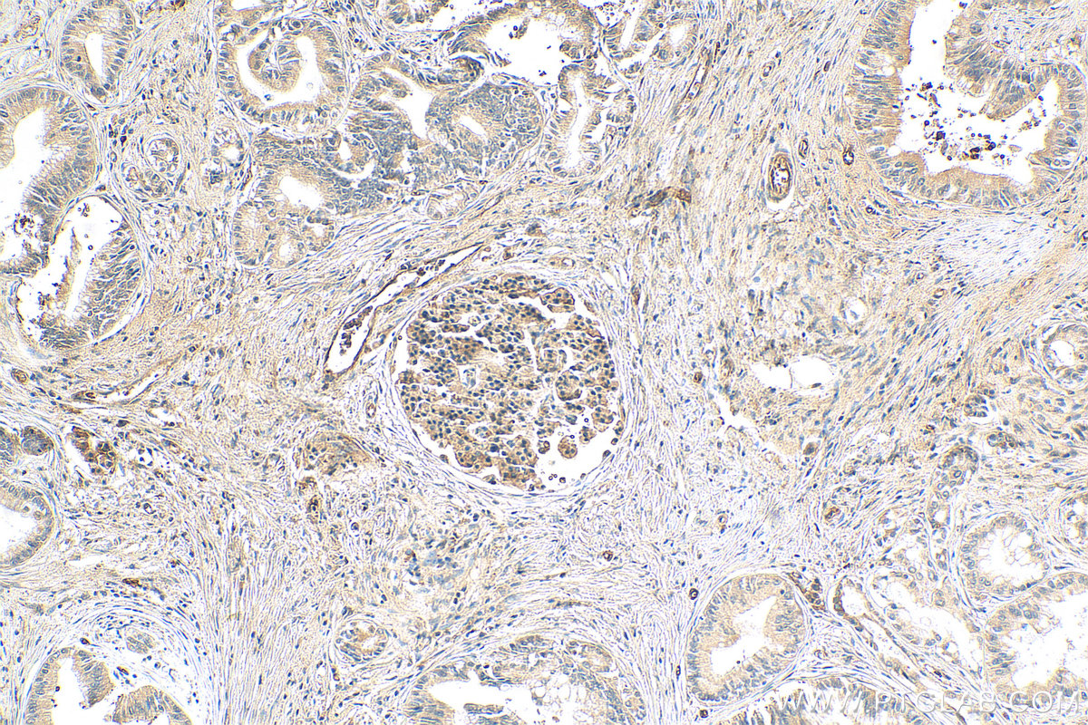 IHC staining of human pancreas cancer using 21699-1-AP