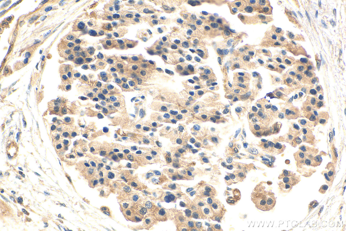 IHC staining of human pancreas cancer using 21699-1-AP