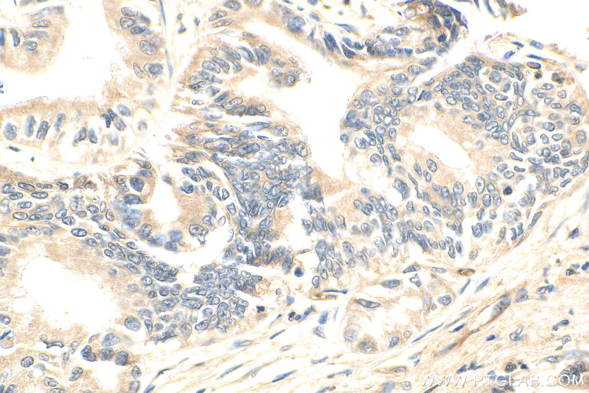 IHC staining of human pancreas cancer using 21699-1-AP