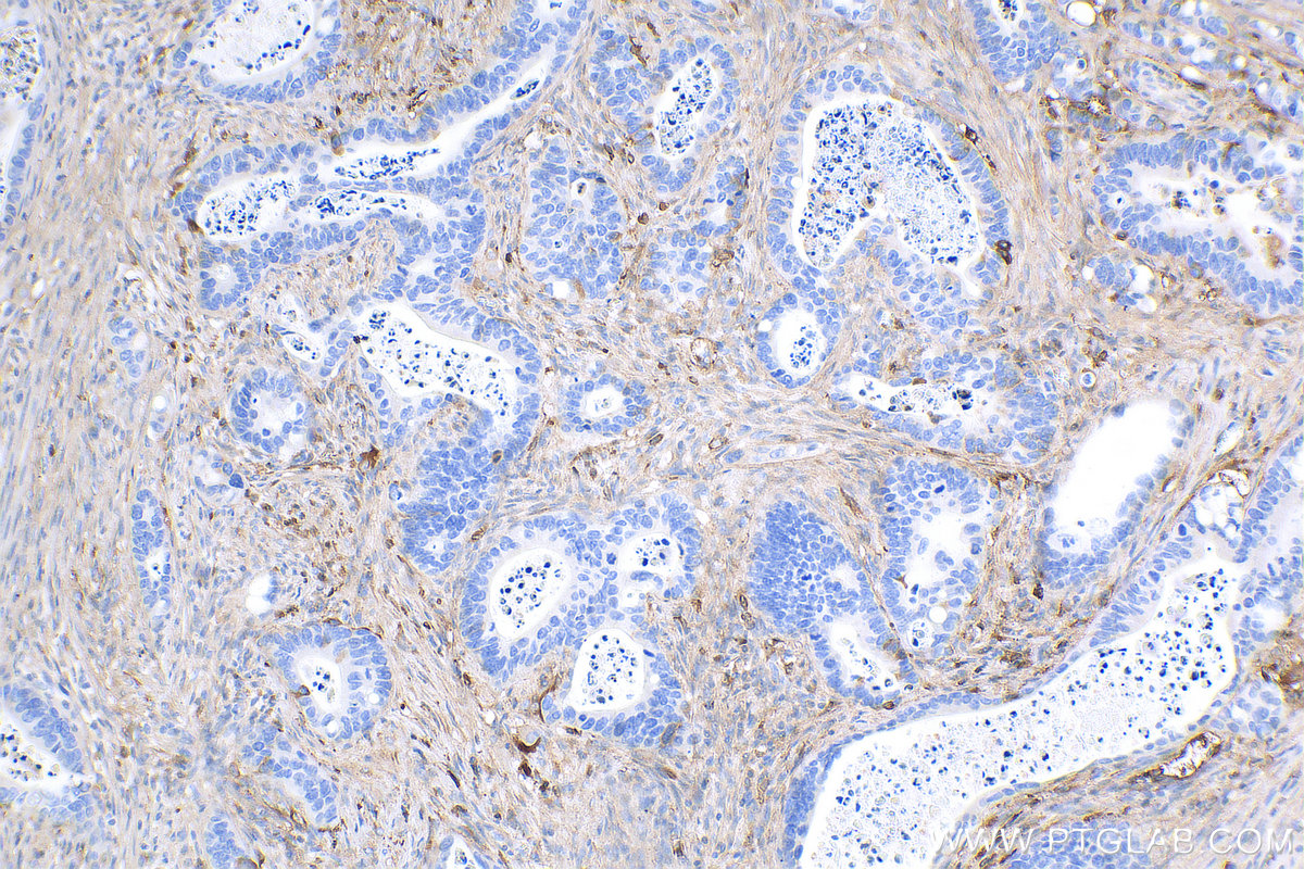 IHC staining of human colon cancer using 14667-1-AP