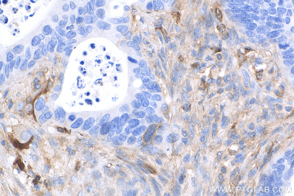 IHC staining of human colon cancer using 14667-1-AP