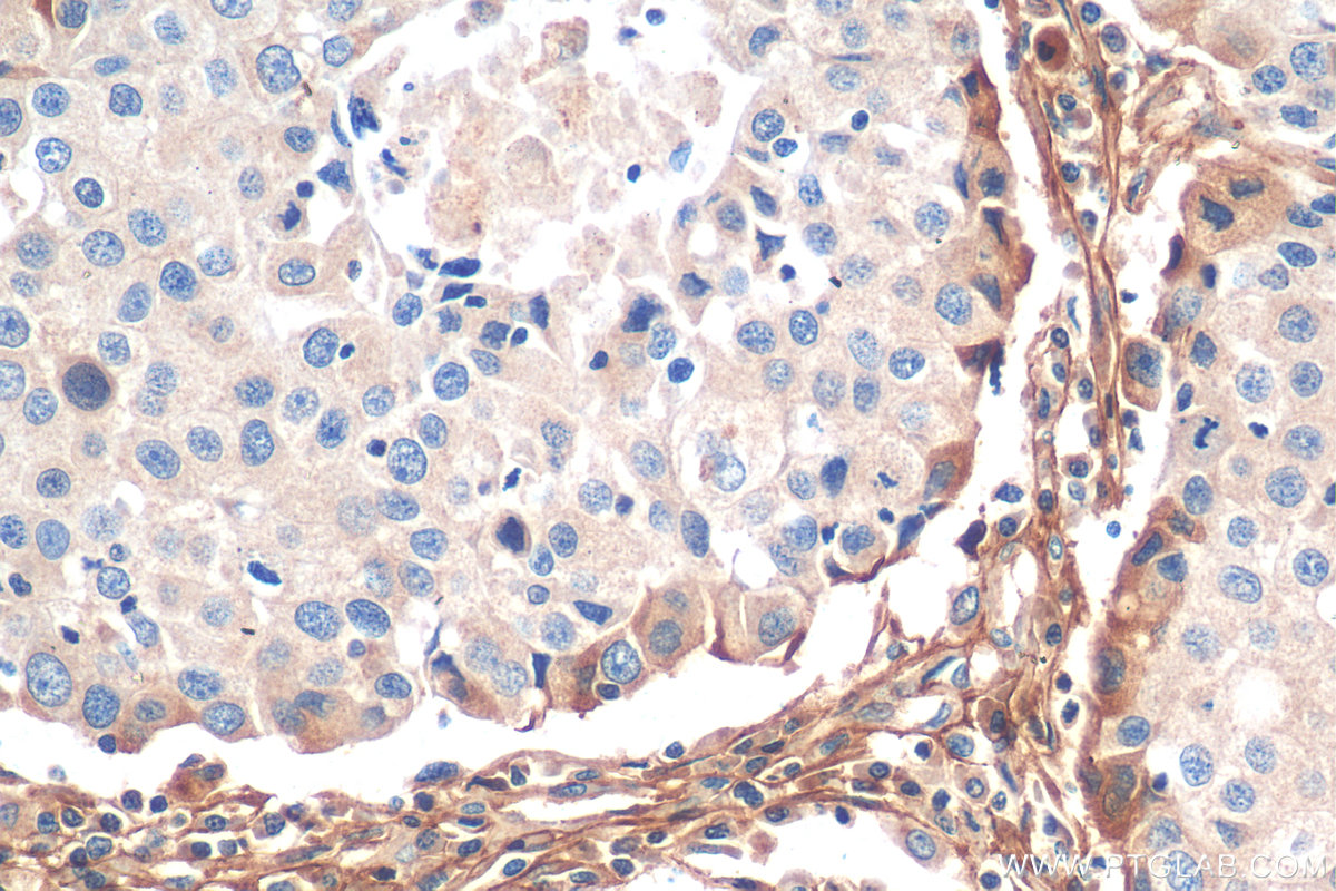 IHC staining of human breast cancer using 14667-1-AP