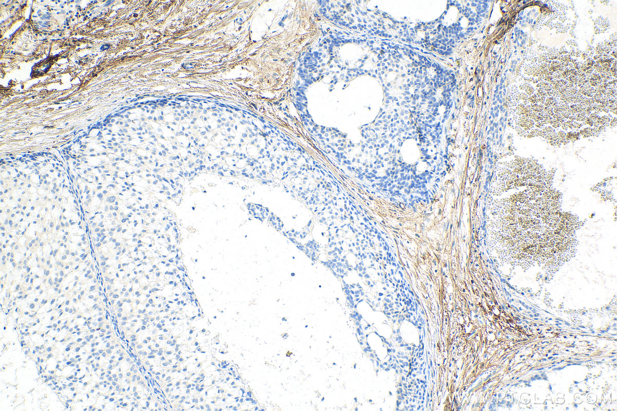 IHC staining of human breast hyperplasia using 14667-1-AP