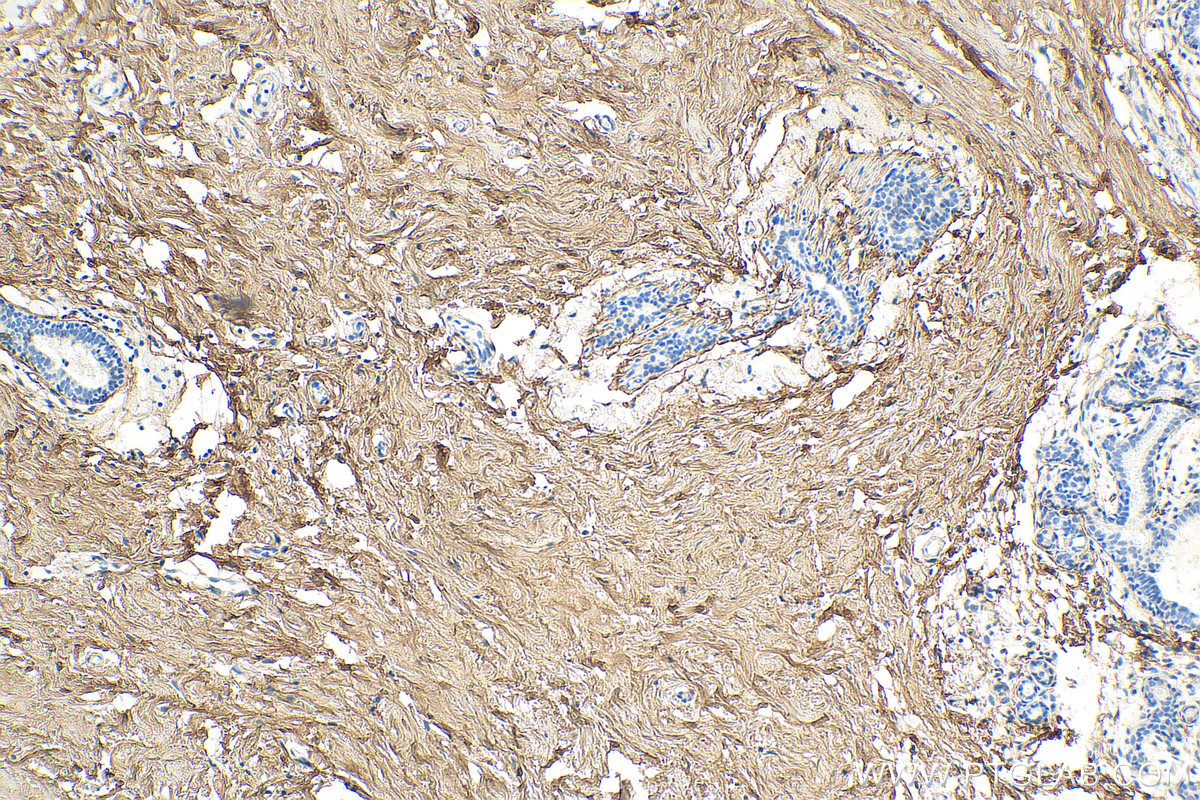 IHC staining of human breast hyperplasia using 14667-1-AP