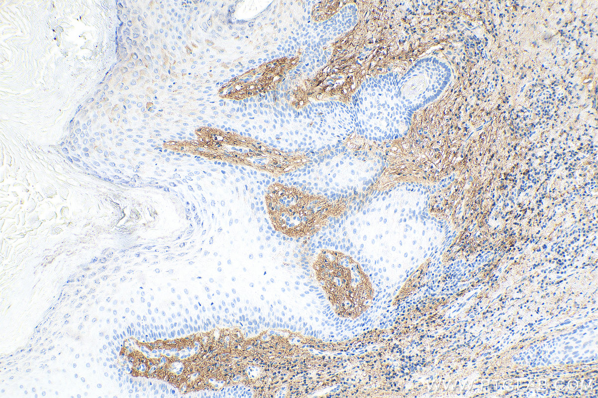 IHC staining of human skin cancer using 14667-1-AP