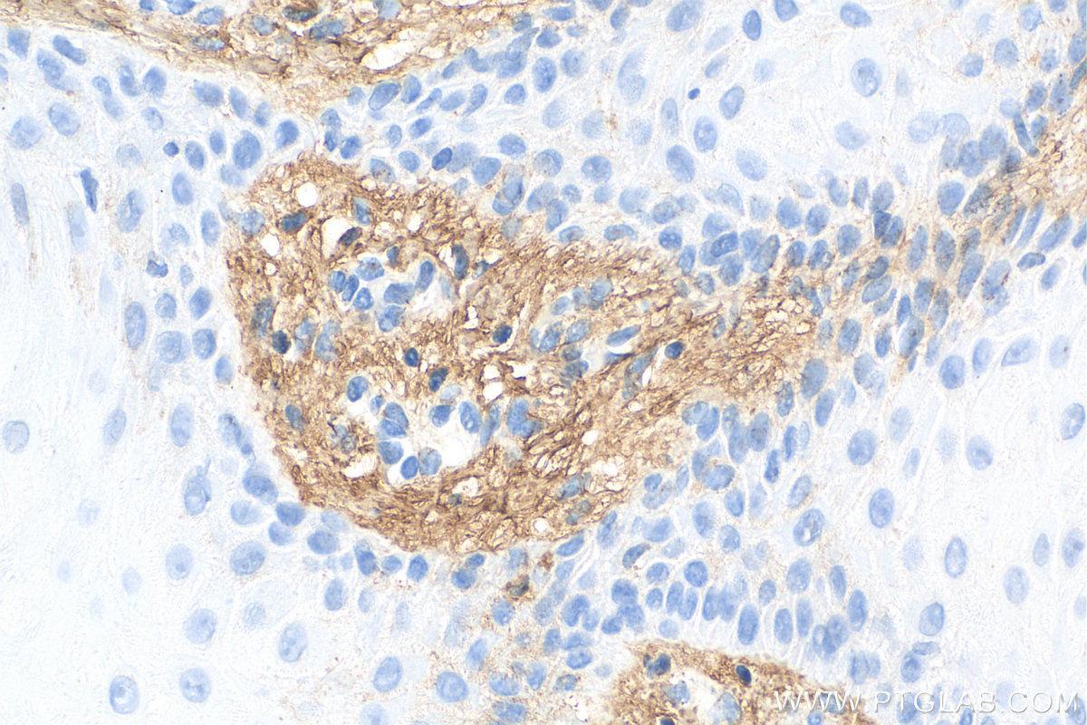 IHC staining of human skin cancer using 14667-1-AP