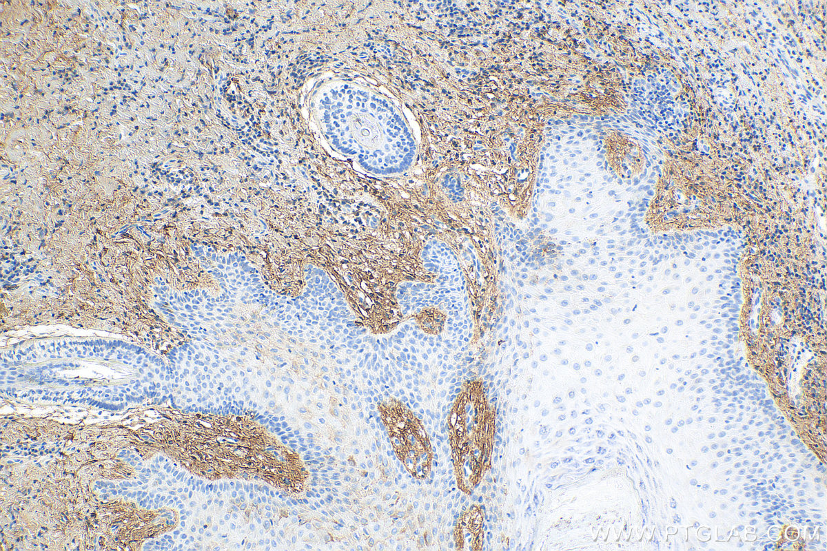 IHC staining of human skin cancer using 14667-1-AP