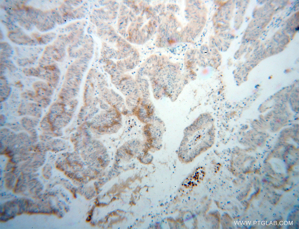 IHC staining of human liver cancer using 13863-1-AP