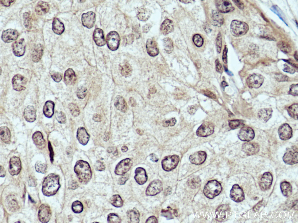 IHC staining of human breast cancer using 67311-1-Ig