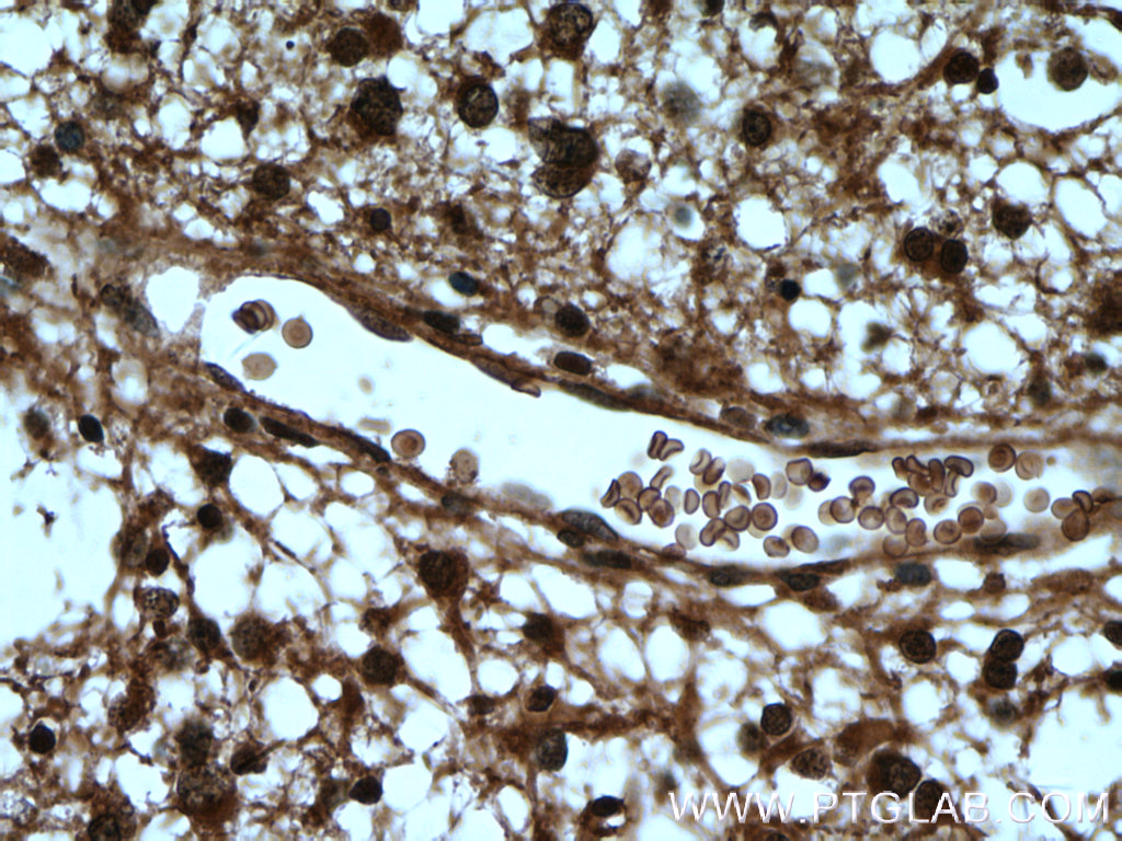 IHC staining of human gliomas using 10965-1-AP