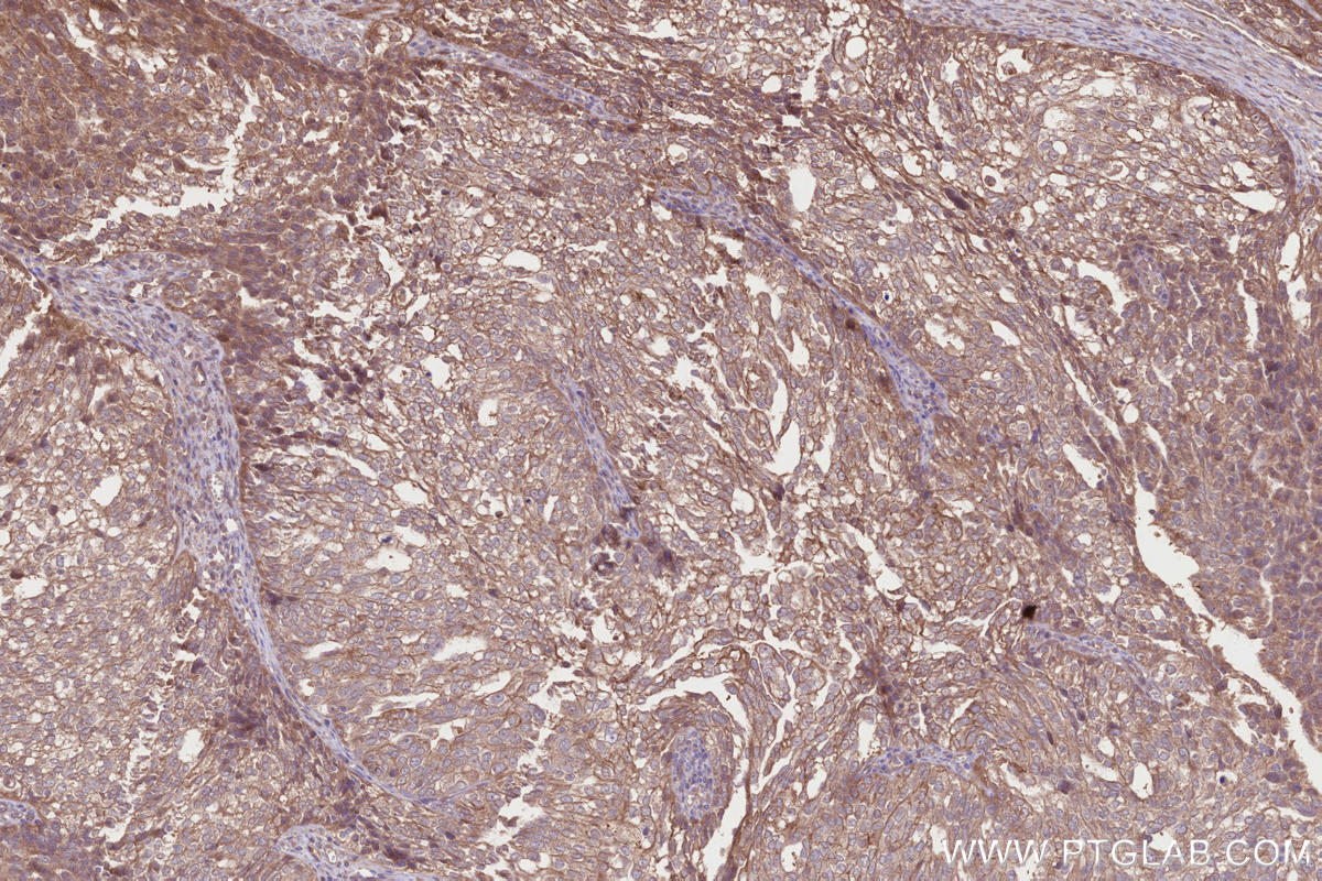 IHC staining of human ovary cancer using 26356-1-AP