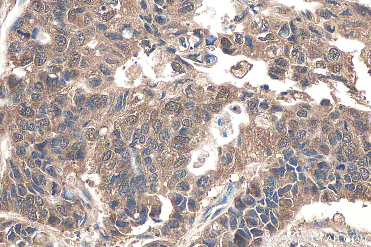 IHC staining of human stomach cancer using 30108-1-AP