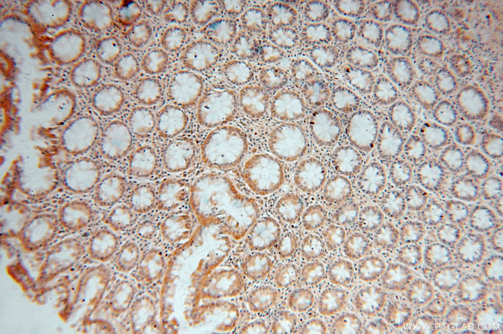 IHC staining of human colon cancer using 14966-1-AP