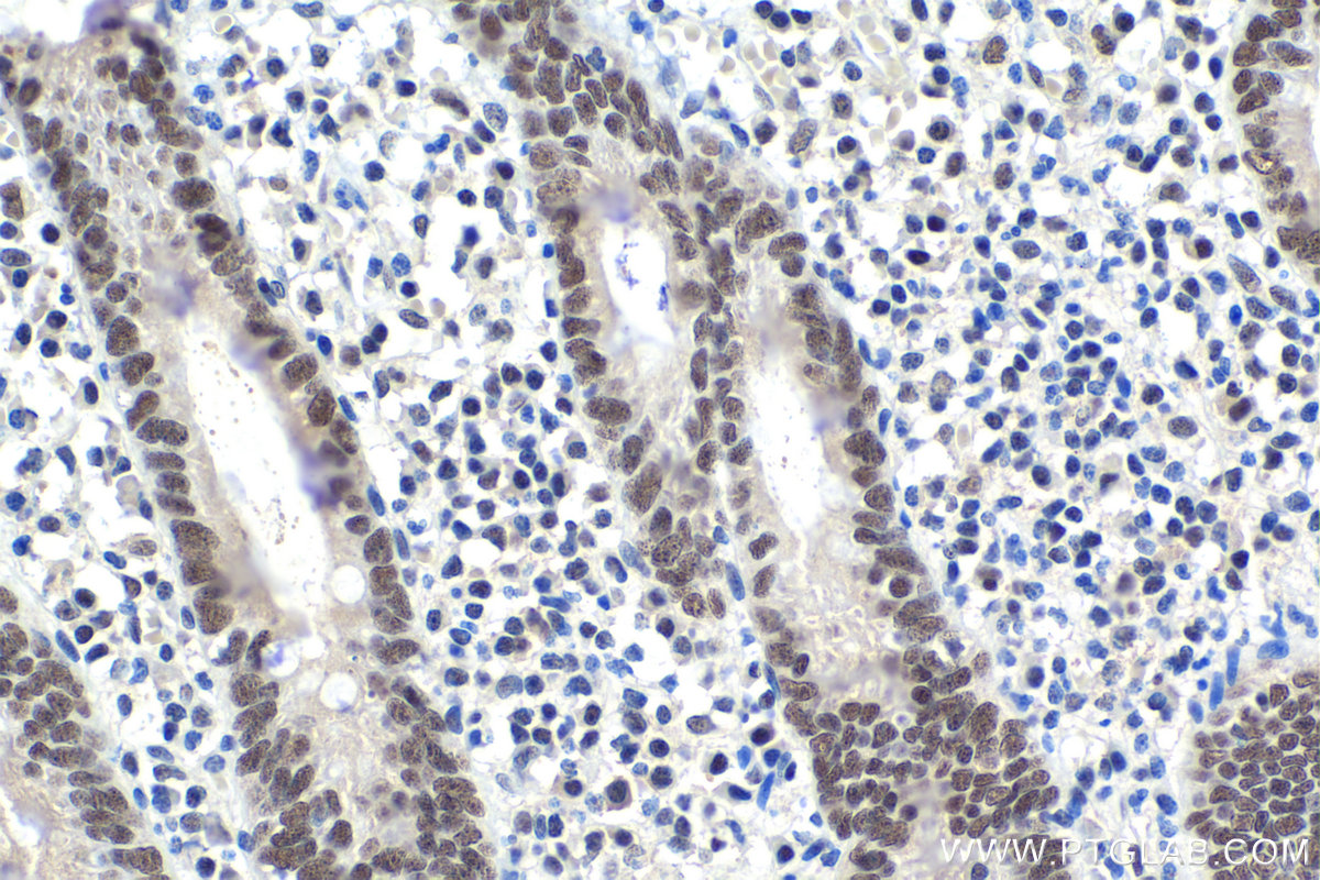 IHC staining of human appendicitis using 66010-1-Ig