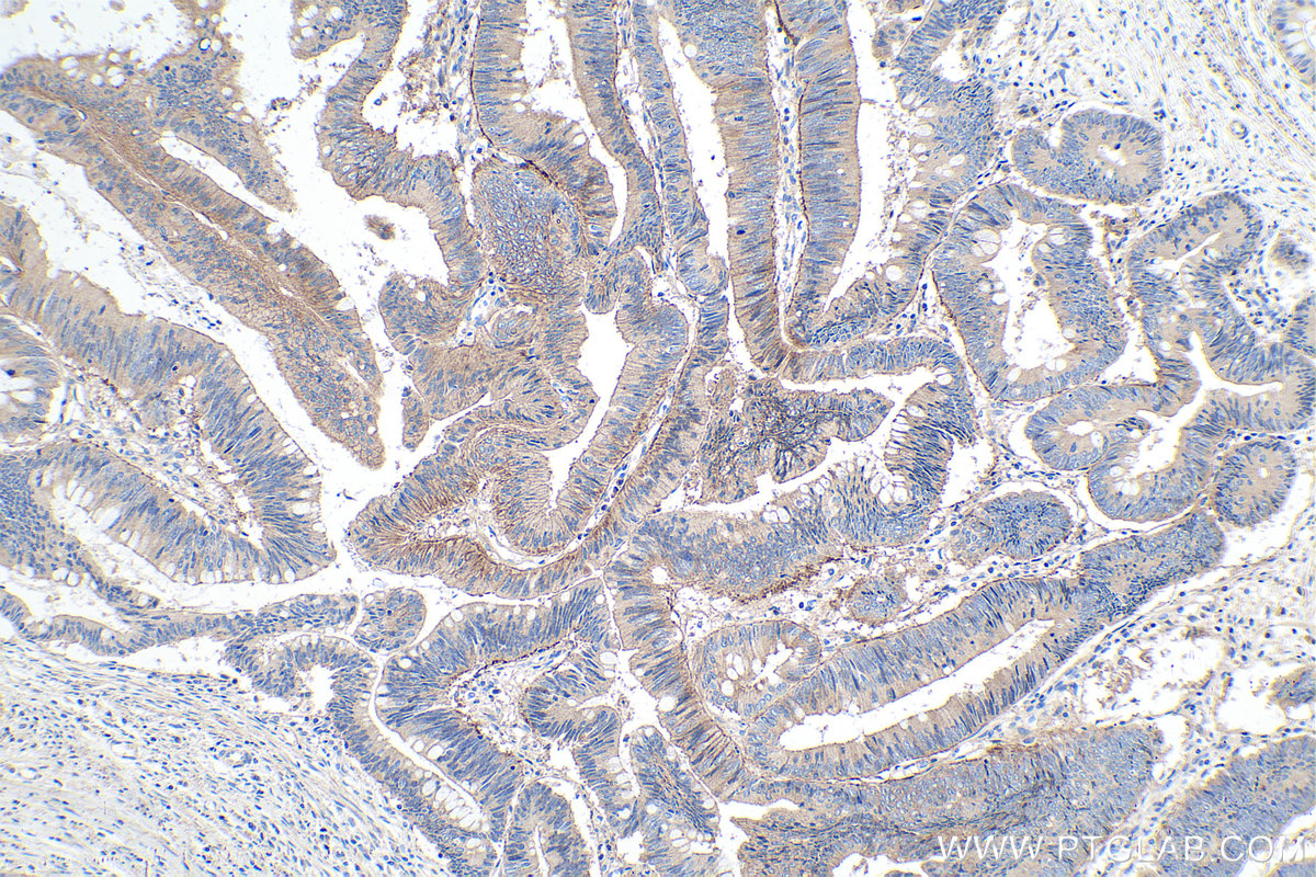 IHC staining of human colon cancer using 10536-1-AP