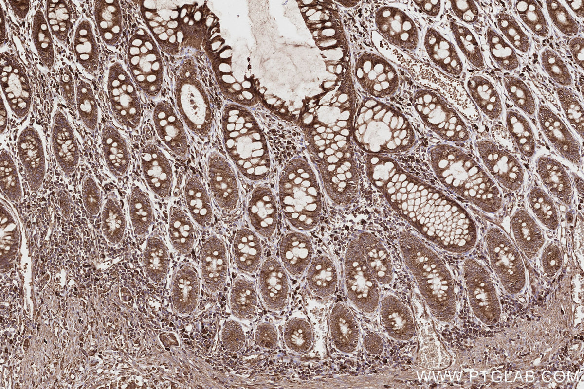 IHC staining of human rectal cancer using 21445-1-AP IHC staining of human rectal cancer using 21445-1-AP