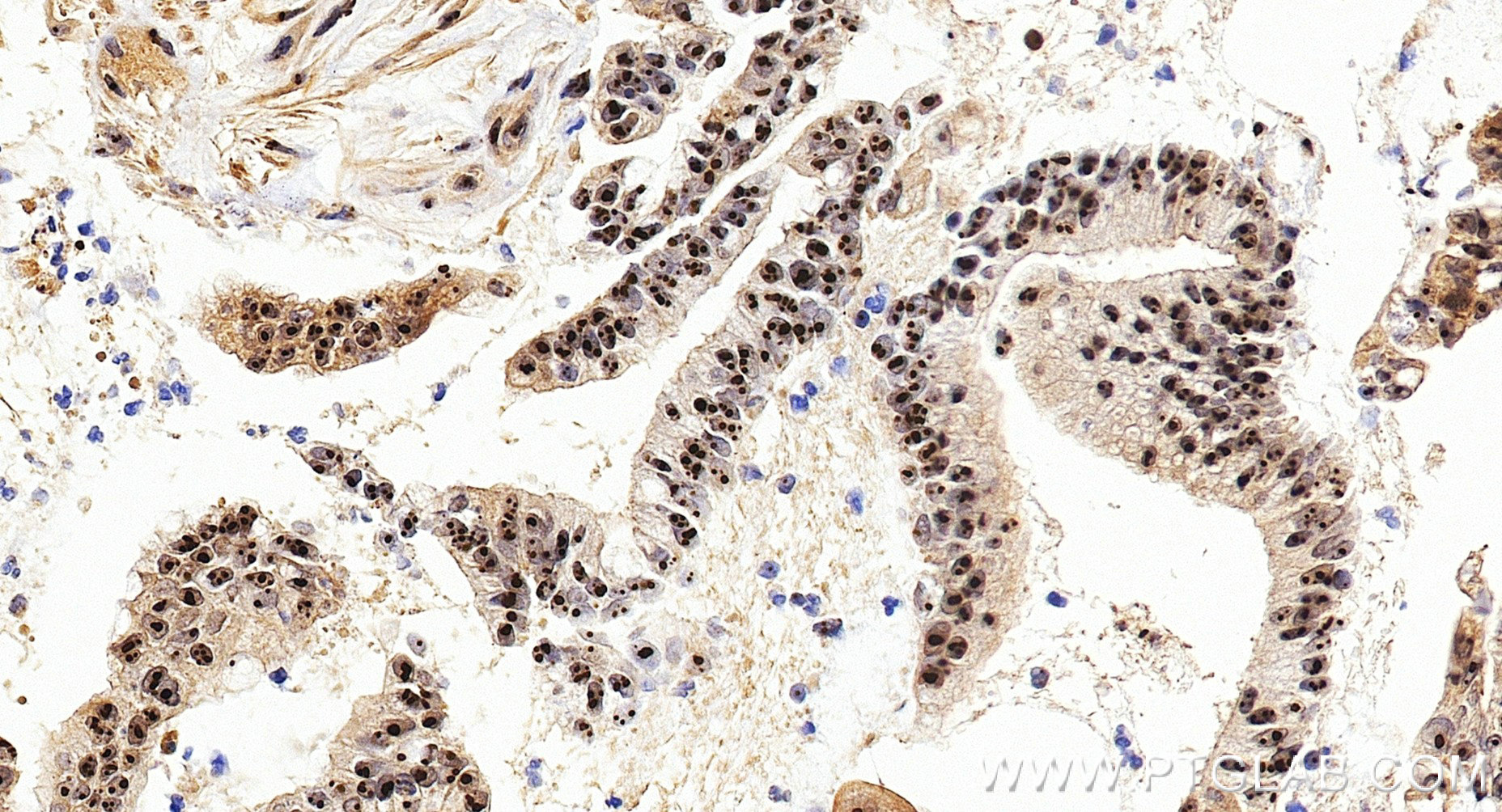 IHC staining of human colon cancer using 85789-3-RR