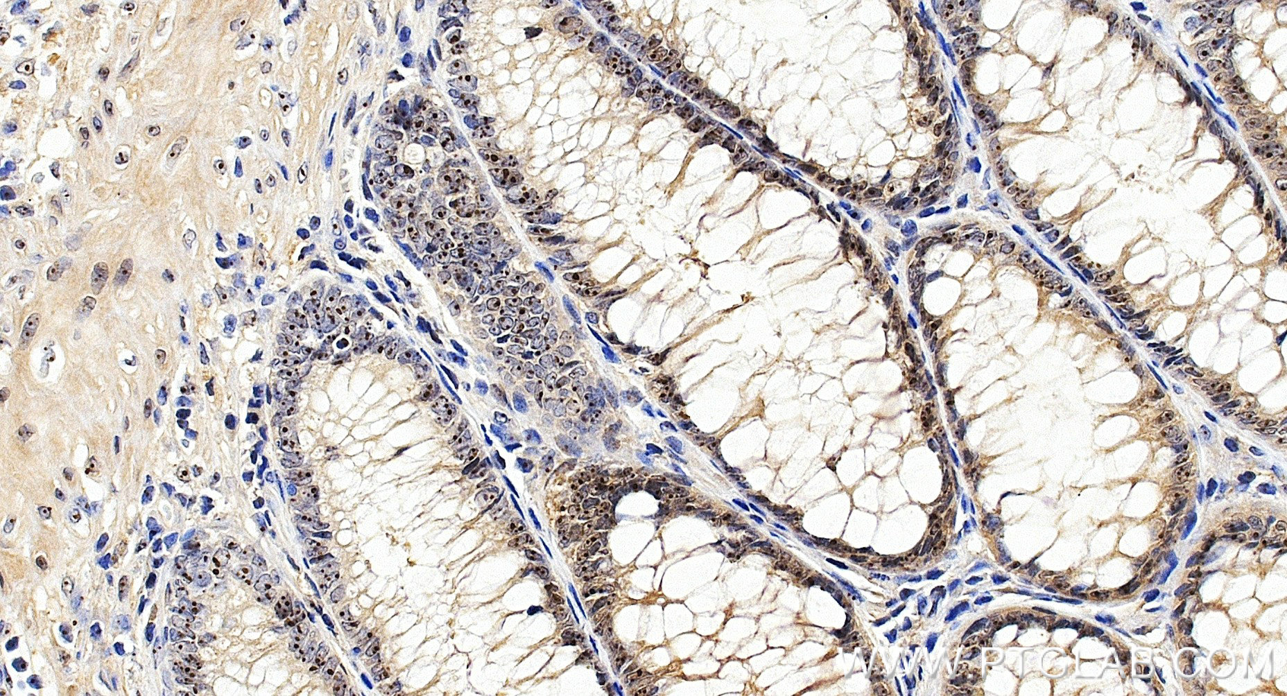 IHC staining of human colon cancer using 85789-3-RR