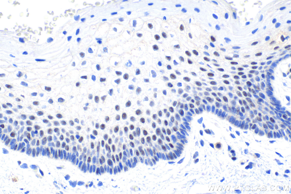 IHC staining of human cervical cancer using 10199-2-AP IHC staining of human cervical cancer using 10199-2-AP