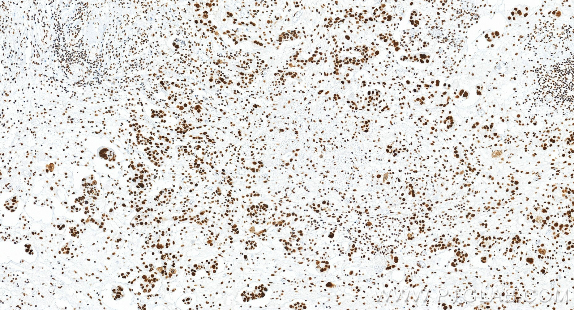 IHC staining of human ovary cancer using 85763-4-RR
