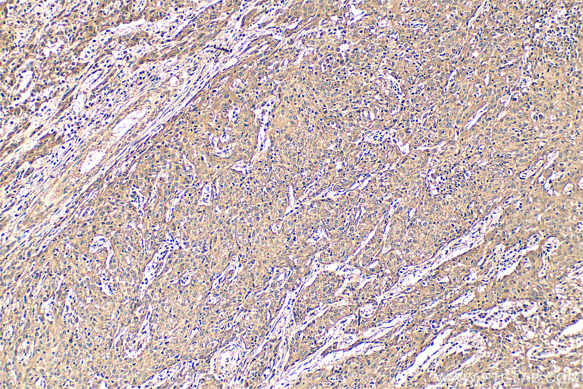 Immunohistochemical analysis of paraffin-embedded human cervical cancer tissue slide using 11115-1-AP (DDX3 antibody) at dilution of 1:200 (under 10x lens). Heat mediated antigen retrieval with Tris-EDTA buffer (pH 9.0). IHC staining of human cervical cancer using 11115-1-AP