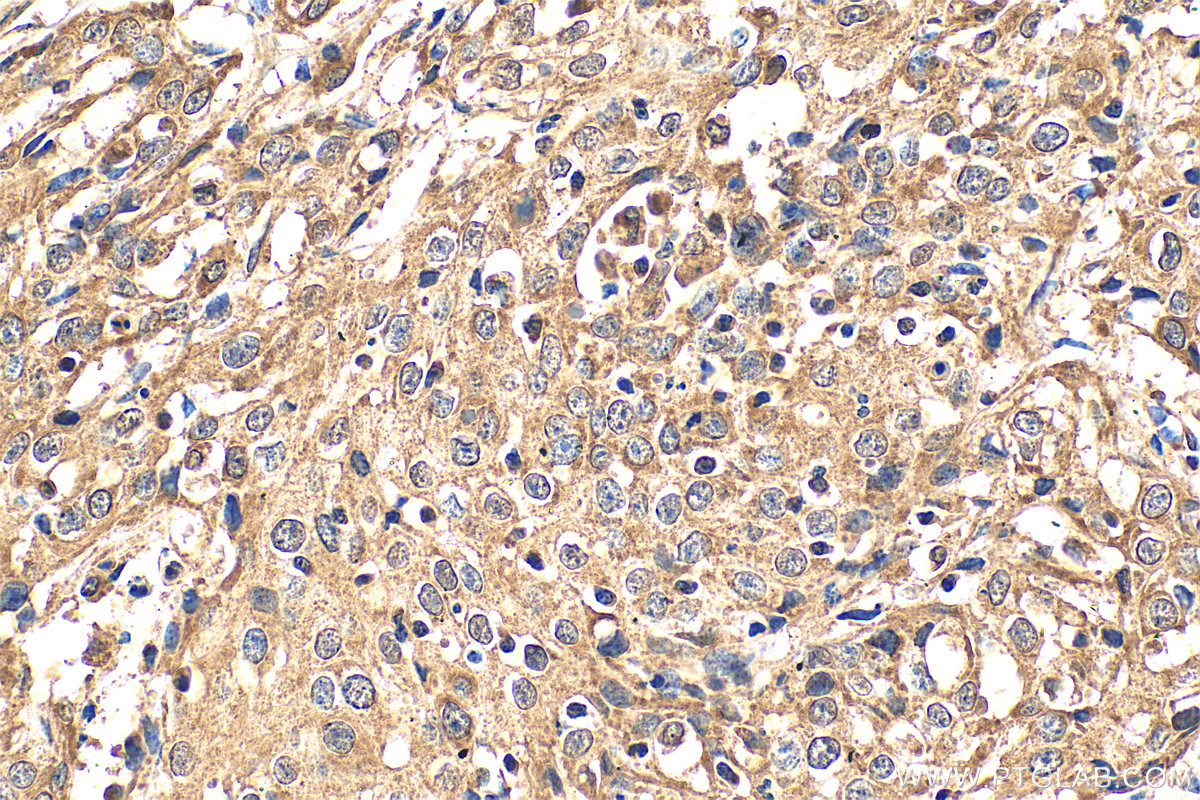 Immunohistochemical analysis of paraffin-embedded human cervical cancer tissue slide using 11115-1-AP (DDX3 antibody) at dilution of 1:200 (under 40x lens). Heat mediated antigen retrieval with Tris-EDTA buffer (pH 9.0). IHC staining of human cervical cancer using 11115-1-AP