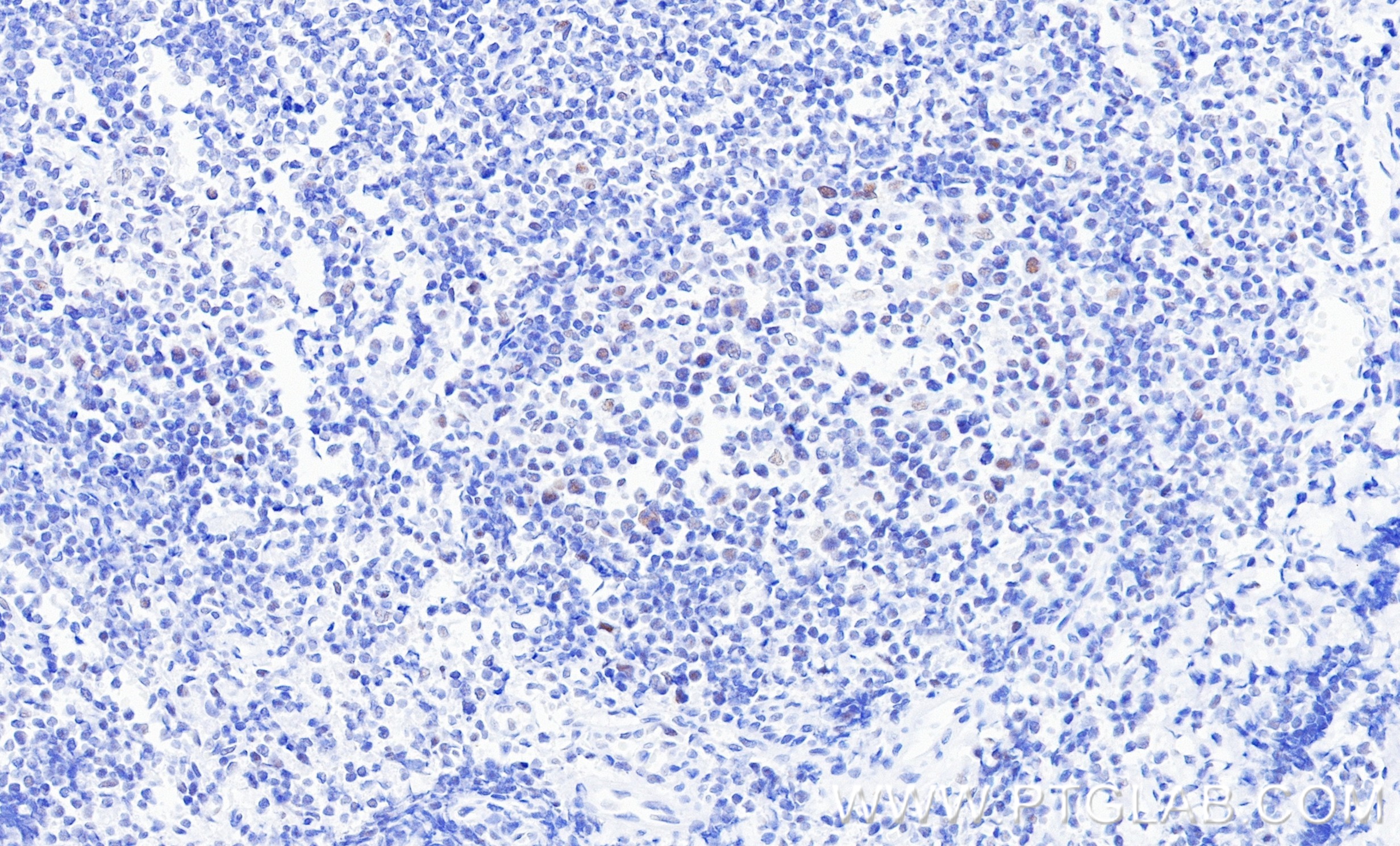IHC staining of human tonsillitis using 86894-1-RR (same clone as 86894-1-PBS) IHC staining of human tonsillitis using 86894-1-RR (same clone as 86894-1-PBS)
