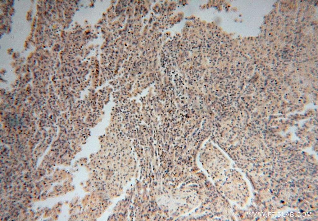 IHC staining of human lung cancer using 17591-1-AP