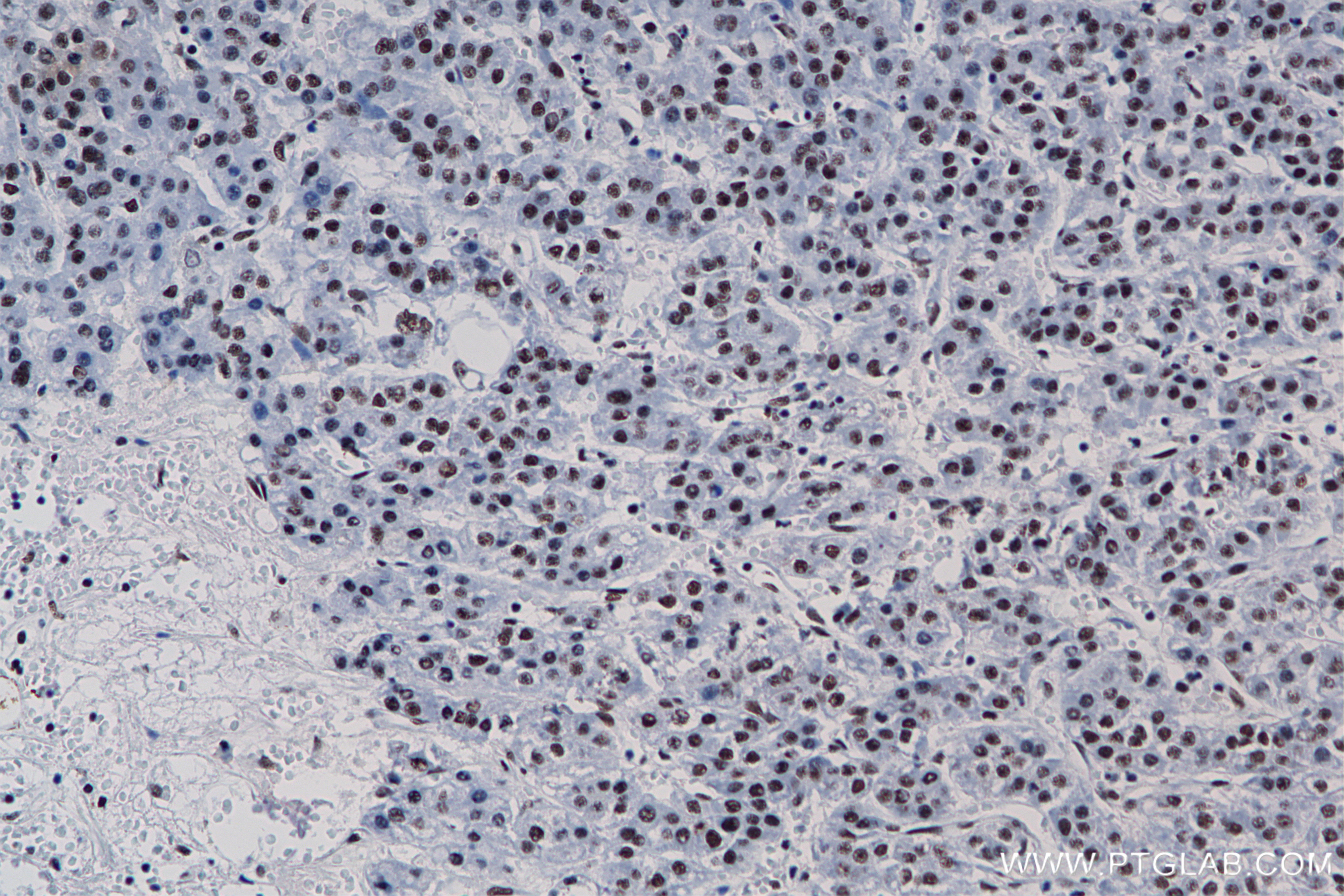 IHC staining of Human Hepatocellular cancer using 85065-3-RR