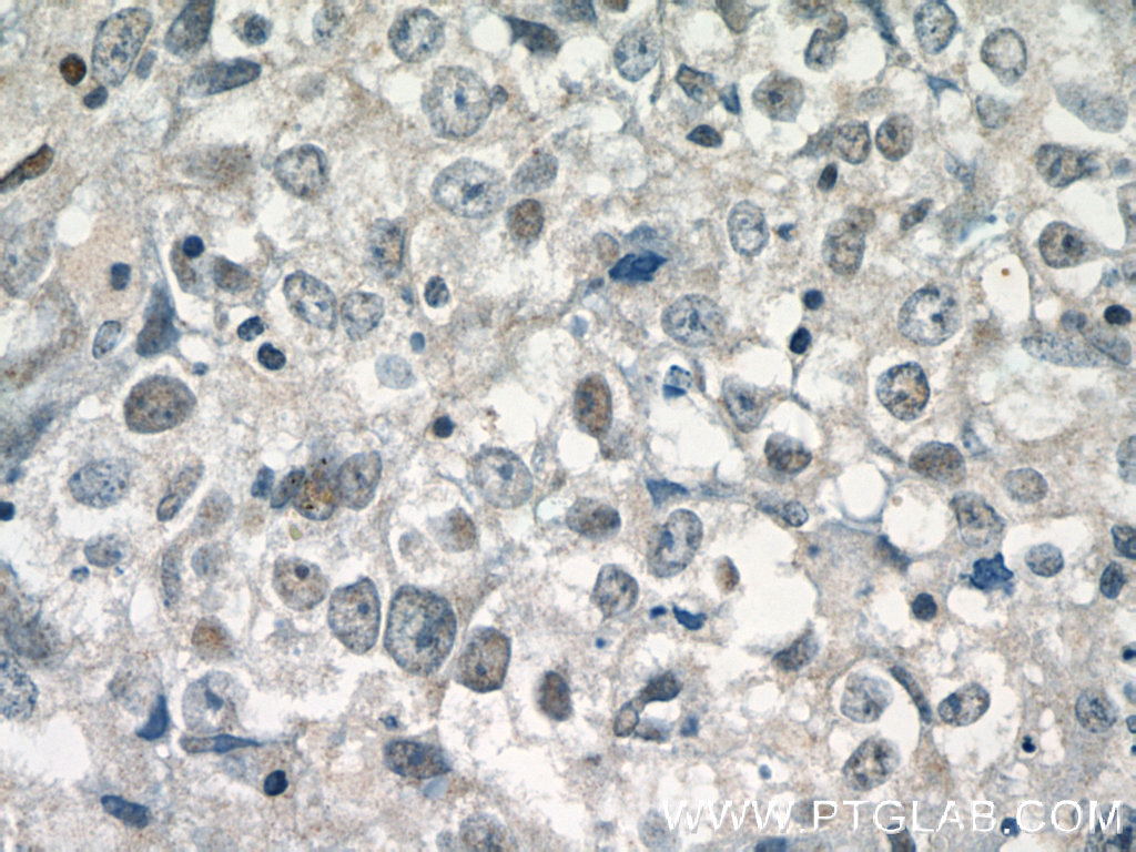 IHC staining of human breast cancer using 10804-1-AP (same clone as 10804-1-PBS)