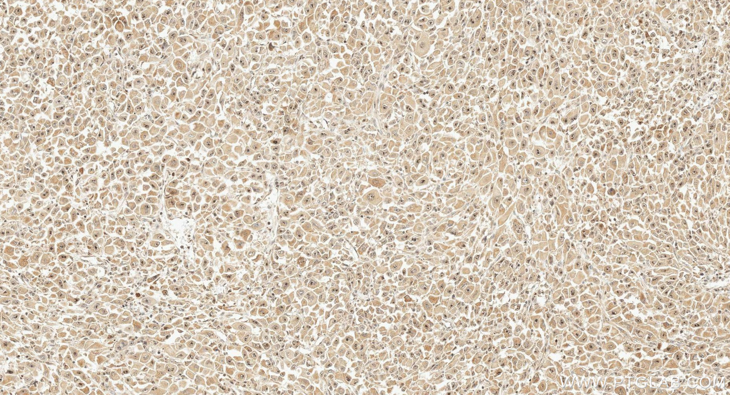 IHC staining of human stomach cancer using 26894-1-AP IHC staining of human stomach cancer using 26894-1-AP