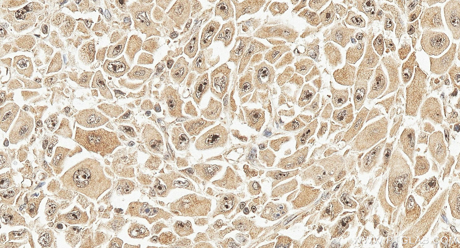 IHC staining of human stomach cancer using 26894-1-AP IHC staining of human stomach cancer using 26894-1-AP