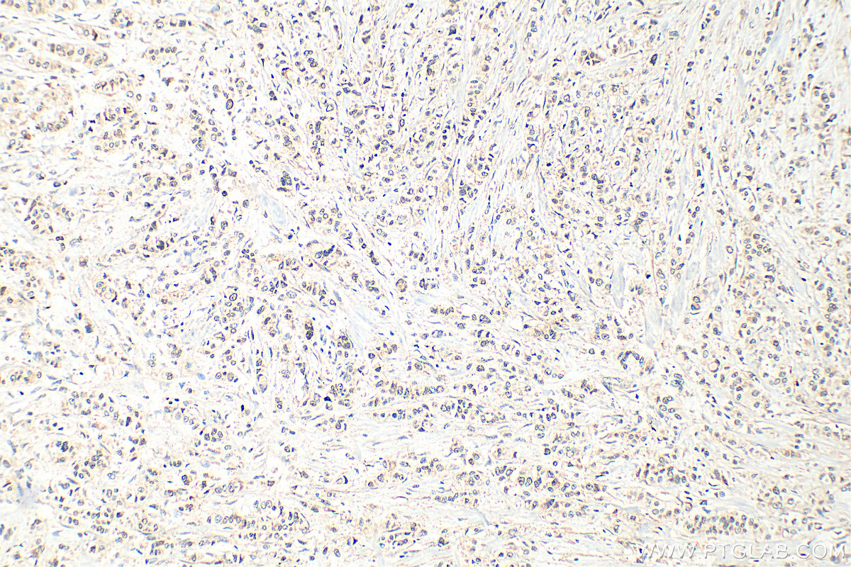 IHC staining of human breast cancer using 32948-1-AP