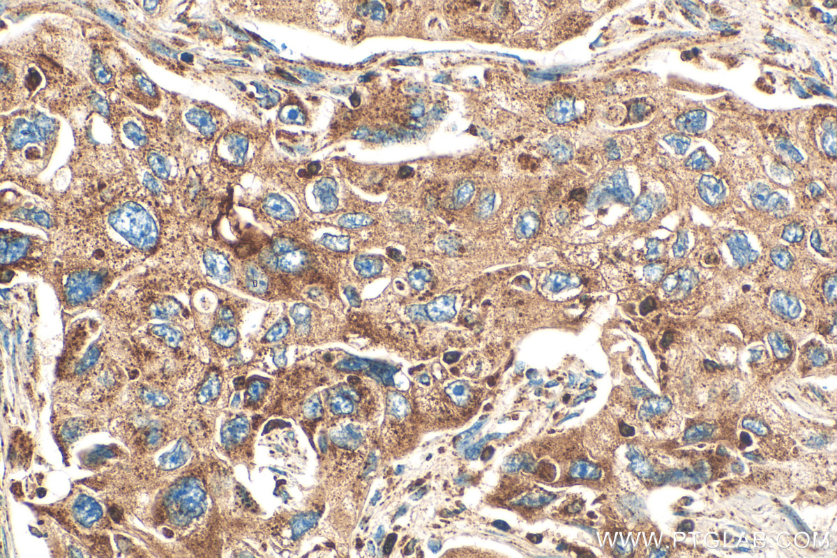 IHC staining of human lung cancer using 82969-4-RR