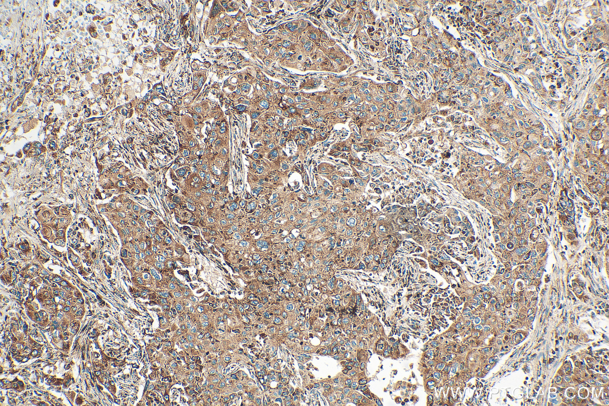 IHC staining of human lung cancer using 82969-4-RR