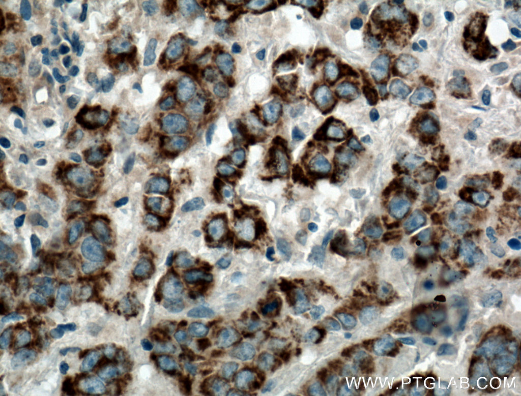 IHC staining of human prostate cancer using 25021-1-AP