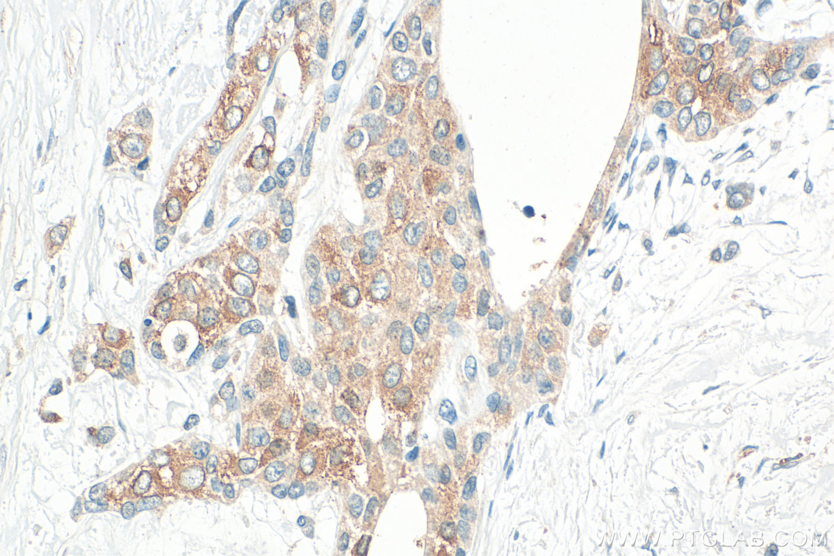 IHC staining of human urothelial carcinoma using 33219-1-AP IHC staining of human urothelial carcinoma using 33219-1-AP