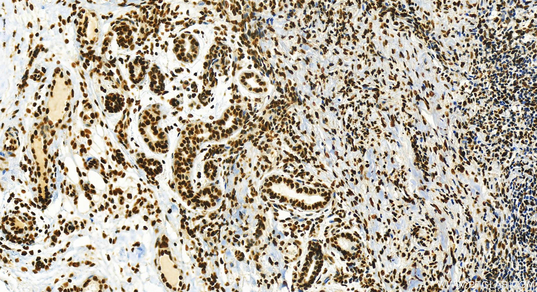 IHC staining of human skin cancer using 82880-1-RR