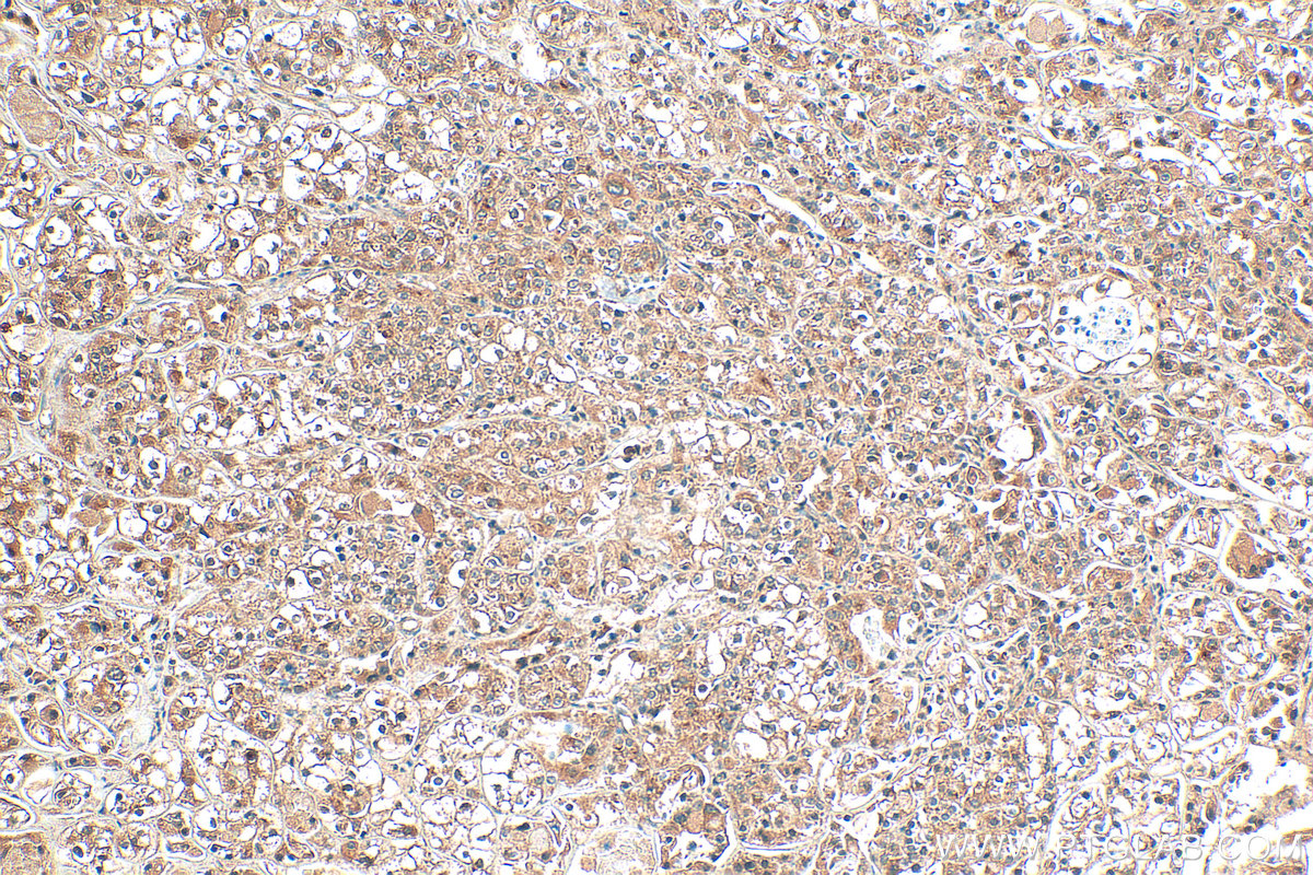 Immunohistochemical analysis of paraffin-embedded human endometrial cancer tissue slide using 25658-1-AP (DENND1A antibody) at dilution of 1:200 (under 10x lens). Heat mediated antigen retrieval with Tris-EDTA buffer (pH 9.0). IHC staining of human endometrial cancer using 25658-1-AP