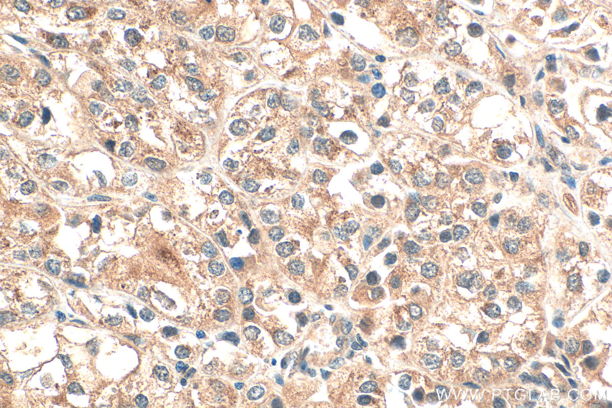 Immunohistochemical analysis of paraffin-embedded human endometrial cancer tissue slide using 25658-1-AP (DENND1A antibody) at dilution of 1:200 (under 40x lens). Heat mediated antigen retrieval with Tris-EDTA buffer (pH 9.0). IHC staining of human endometrial cancer using 25658-1-AP