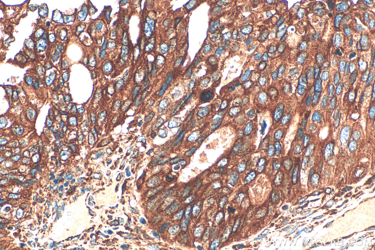 IHC staining of human ovary tumor using 33113-1-AP (same clone as 33113-1-PBS)