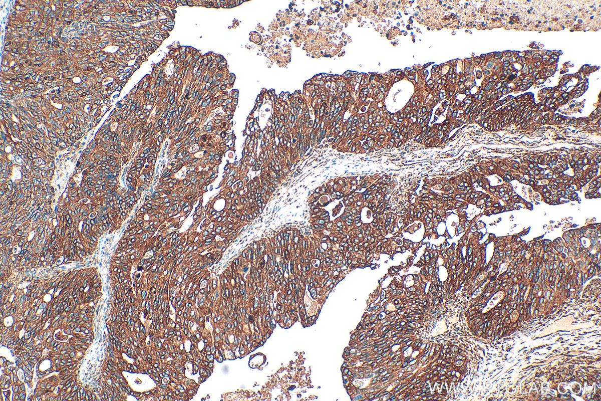 IHC staining of human ovary tumor using 33113-1-AP (same clone as 33113-1-PBS)